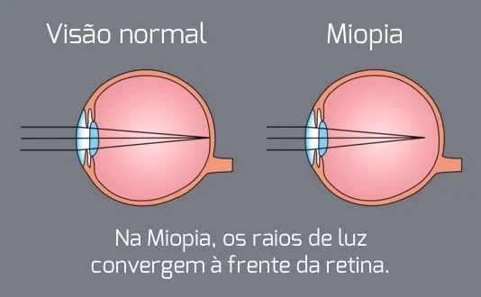 Mundo vive epidemia de miopia, diz OMS